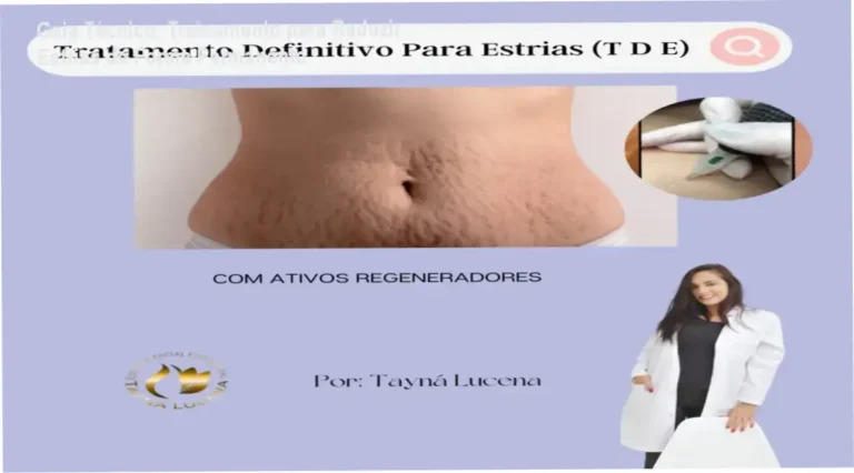Método TDE para tratamento de estrias com Tayna de Lucena Silva - bastidores do curso.