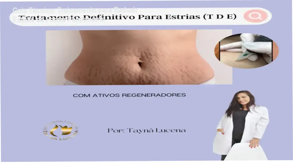 Método TDE para tratamento de estrias com Tayna de Lucena Silva - bastidores do curso.